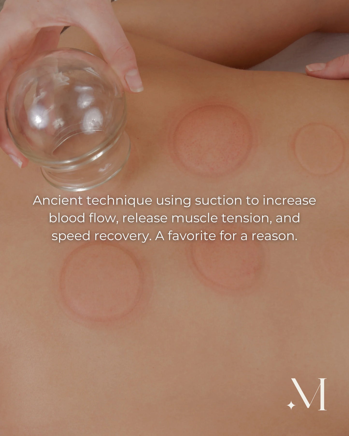 Massage met glazen cupping op de blote rug met cirkelvormige zuignappen, een ontspannende wellnessbehandeling.