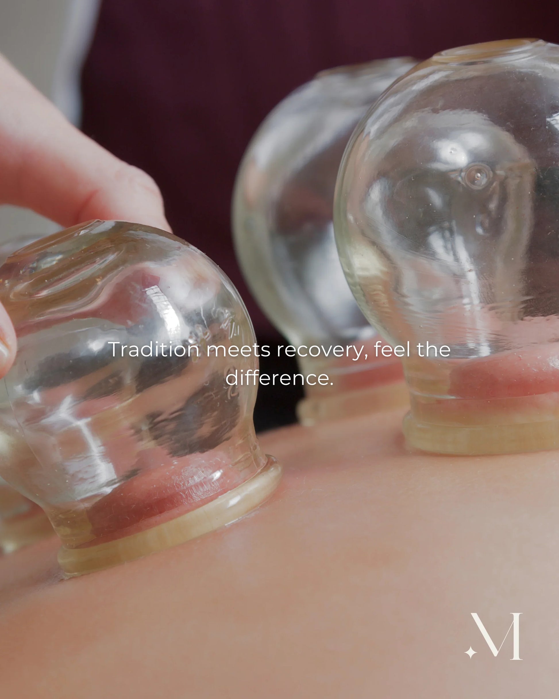 Close-up van glazen cups op de huid tijdens een therapeutische cuppingmassage.